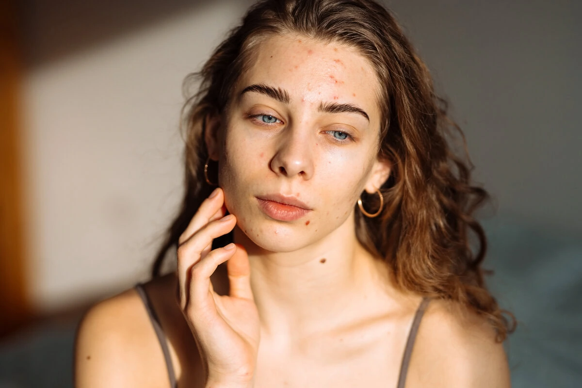 Woman experiencing active forehead and chin breakouts.