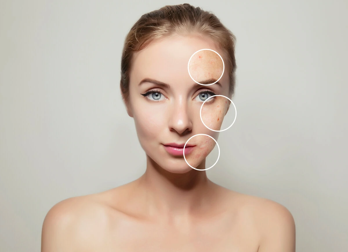 Woman with highlighted areas on her face showing skin imperfections, blemishes, or hyperpigmentation.