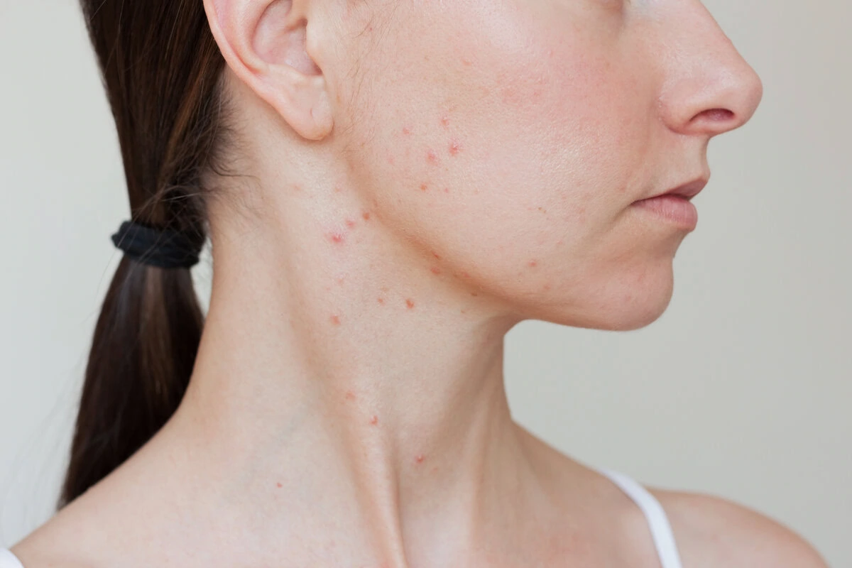Woman dealing with jawline and neck pimples and breakouts.
